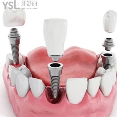 深圳質(zhì)美口腔韓國登騰種植體包干價(jià)貴不？