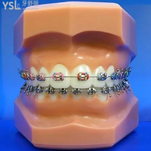 蘭州皓亞口腔牙齒矯正（傳統(tǒng)托槽）多少錢？