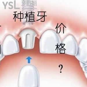 天津美奧口腔貴嗎？可以參考下進(jìn)口種植牙收費(fèi)如何。