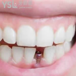 請(qǐng)參考下寧波牙博士口腔醫(yī)院種植牙價(jià)格表，再說收費(fèi)貴嗎？