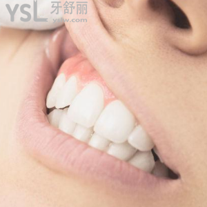 成都圣貝牙科醫(yī)院價(jià)格表之時(shí)代天使隱形矯正優(yōu)惠來嘍！