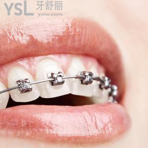 正畸為什么先戴上牙
