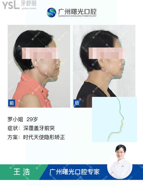 30歲可以矯正牙齒嗎，當(dāng)然可以還解決了我好多問題。