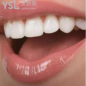 保定合眾口腔價(jià)格表之種植牙一顆多少錢？