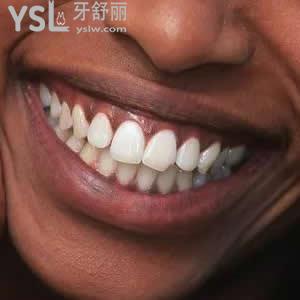 深圳富華醫(yī)院口腔科之金屬自鎖托槽矯正價(jià)格錢多少錢？貴嗎？