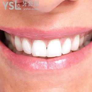 深圳富華醫(yī)院口腔科之時(shí)代天使隱形矯正價(jià)格貴嗎？