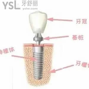 種植體與牙槽骨多久融合到一起？