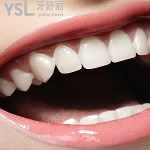 廣州圣貝口腔樹脂補牙價格貴嗎？