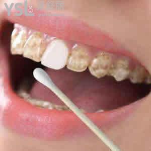 深圳格倫菲爾口腔價(jià)目表之韓國奧齒泰種植體多少錢？