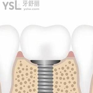 種一顆牙大概要多少錢一顆？