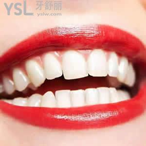 吳江松陵牙博士價(jià)格表之瓷貼面（E-MAX4顆套餐）價(jià)格優(yōu)惠