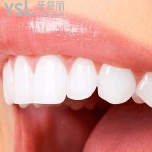 昆明美奧口腔價(jià)格表之傳統(tǒng)金屬矯正收費(fèi)標(biāo)準(zhǔn) ！