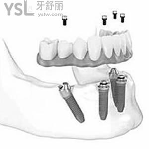 廈門登特口腔收費價格表安排上，其中包含種植牙和矯正的費用