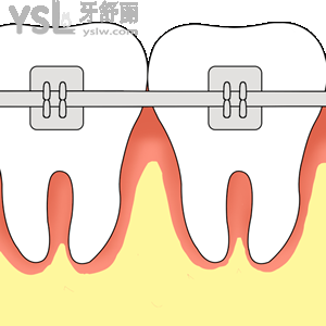 鄭州拜博口腔醫(yī)院牙齒矯正美國ORMCO（金屬）活動(dòng)收費(fèi)標(biāo)準(zhǔn)