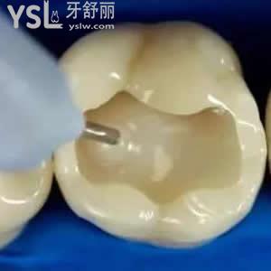 珠海九龍口腔醫(yī)院價格貴嗎？進口3M納米樹脂補牙價格優(yōu)惠。