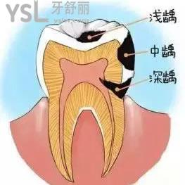 鄭州拜博口腔醫(yī)院價格貴嗎？美國3M納米樹脂補(bǔ)牙活動價可一點(diǎn)都不貴。