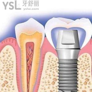 西寧時(shí)光口腔價(jià)格貴嗎？時(shí)光口腔周年慶之種植牙驚喜價(jià)