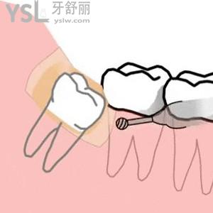 國(guó)產(chǎn)氧化鋯全瓷牙冠價(jià)格，氧化鋯全瓷牙和二氧化鋯全瓷牙有什么區(qū)別？