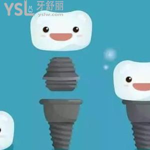 38歲滿口假牙怎么活，如何讓全口種植牙不掉？