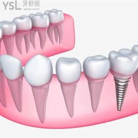 西安海濤口腔醫(yī)院種植牙怎么樣,多少錢一顆？