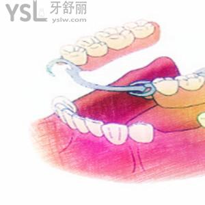活動(dòng)假牙適合年輕人嗎，佩戴10年活動(dòng)假牙有何感受？