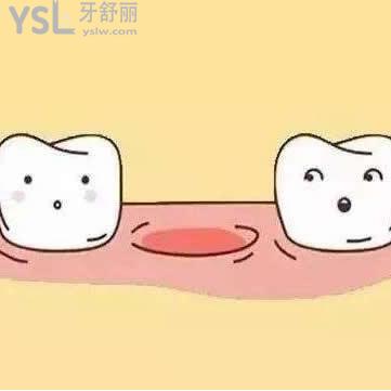 缺牙除了種植牙還有什么辦法？