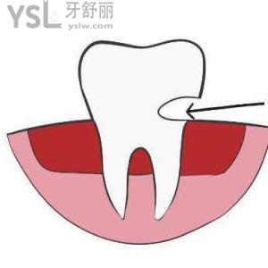 牙齒缺損或缺失后都有哪些修復(fù)方法