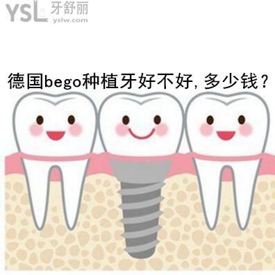 德國bego種植牙好不好多少錢?