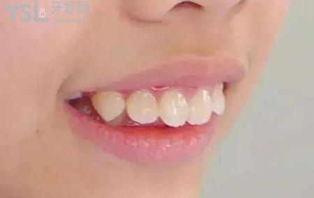 牙齒開頜矯正難度大不大？