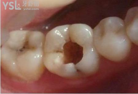 牙齒開髓引流有什么危害？