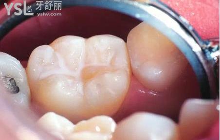 牙齒涂氟多少錢涂一次？