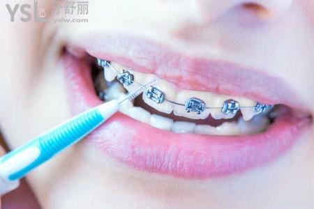 45歲患者矯正牙齒需要多久？