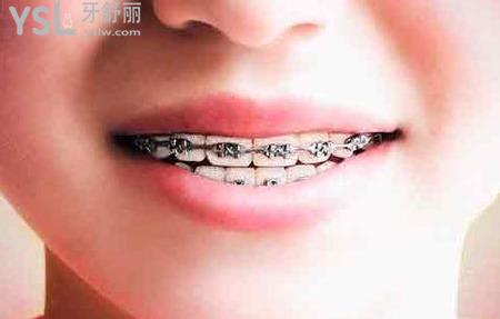 自鎖托槽矯正器是什么？