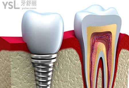 種植牙是什么？