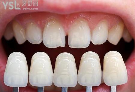 做了牙貼面感覺(jué)像齙牙怎么辦？