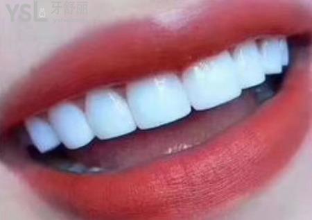 做貼面需要?dú)⒀郎窠?jīng)嗎？