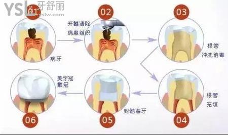根管治療要幾次？