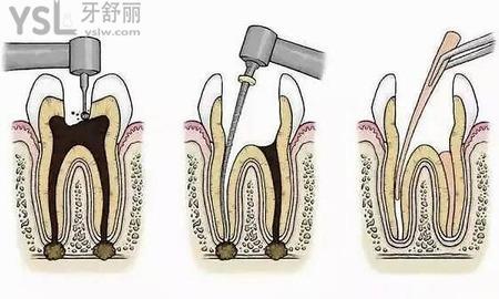 根管治療要多少錢？