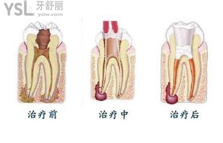 根管治療有什么注意事項(xiàng)？
