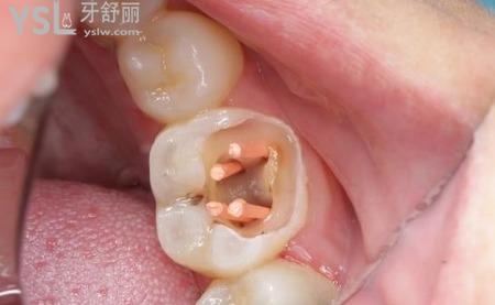 根管治療后注意事項(xiàng)有哪些？