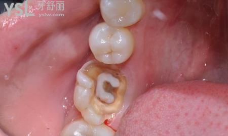 根管治療是怎么回事？