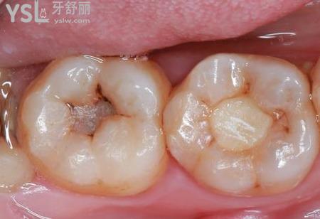 根管治療的危害有哪些？