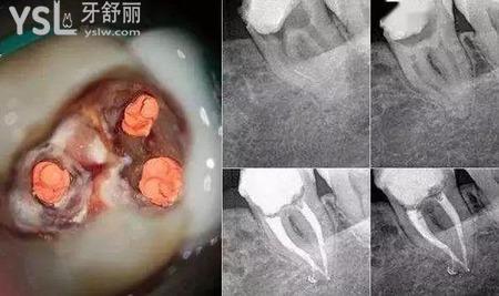 根管治療能用多少年？