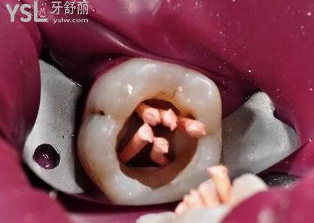根管治療為什么需要顯微鏡？
