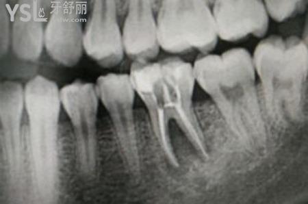 一次根管治療要幾小時(shí)？