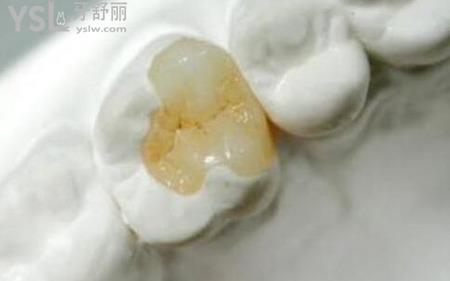什么是嵌體？