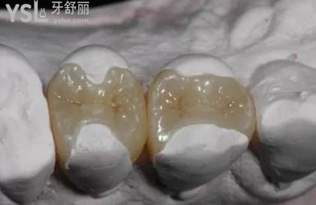 什么是嵌體修復(fù)？