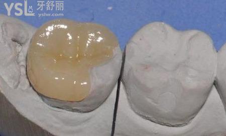 嵌體好還是烤瓷牙好？
