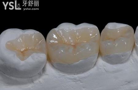 嵌體使用的注意事項有什么？