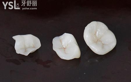 嵌體為什么老是掉？